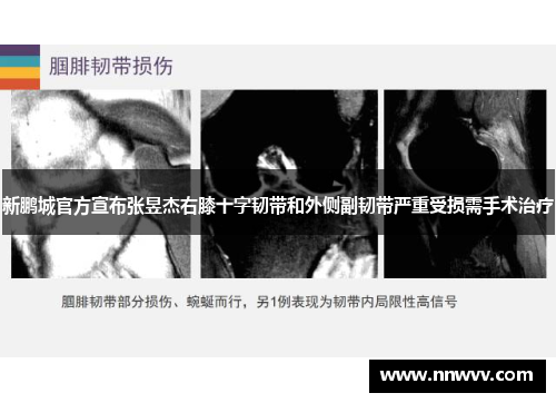 新鹏城官方宣布张昱杰右膝十字韧带和外侧副韧带严重受损需手术治疗